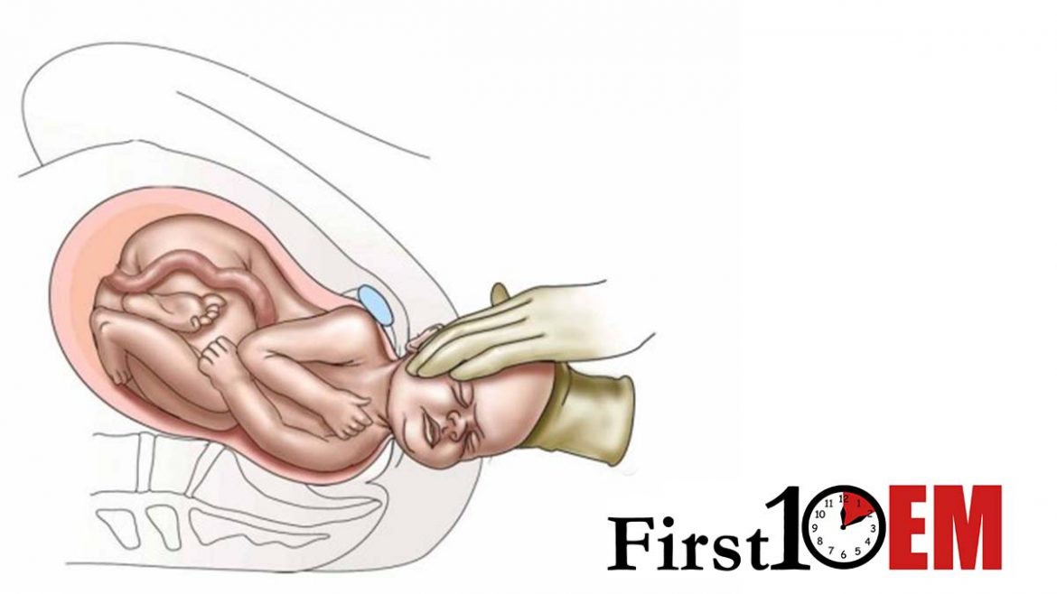 Precipitous delivery