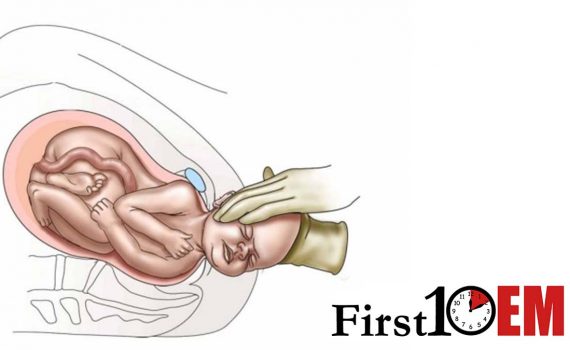 Precipitous delivery