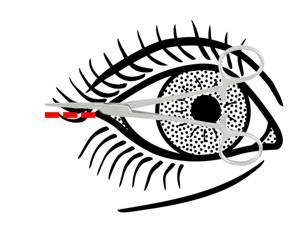 Lateral Canthotomy - procedure guide - First10EM