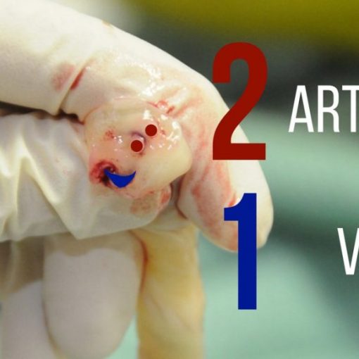 Umbilical Vein Catheterization