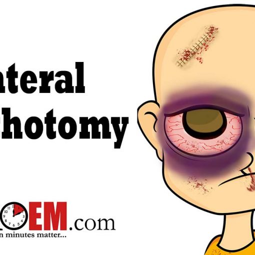 Orbital compartment syndrome catholysis title image