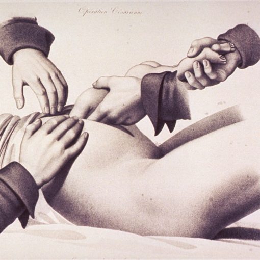 perimortem c-section