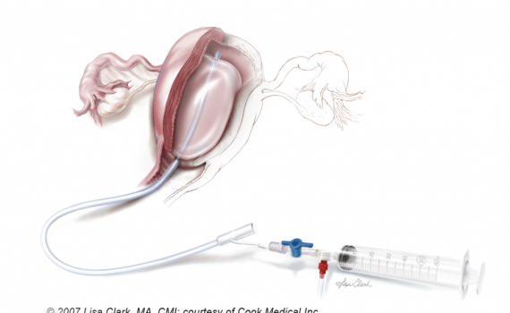 postpartum hemorrhage title image