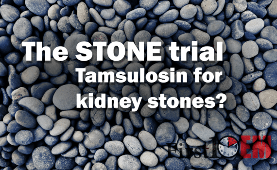 Tamsulosin for kidney stones