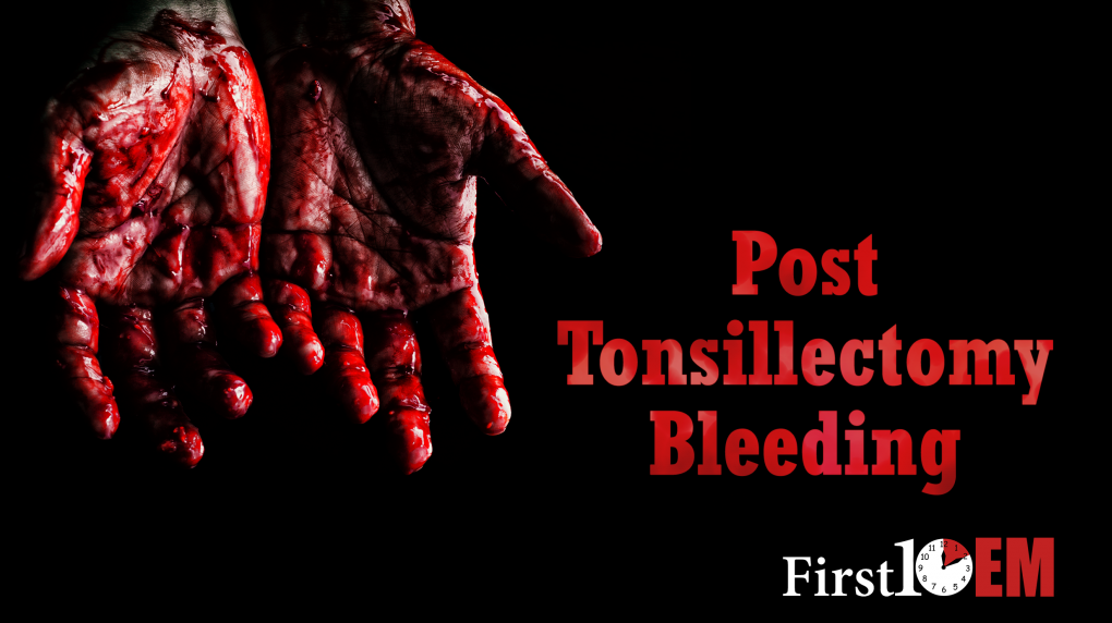 Tonsillectomy hemorrhage