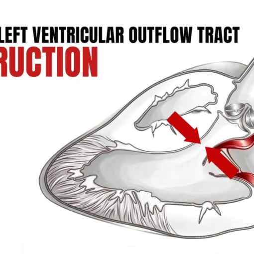 Dynamic Left Ventricular Outflow Tract Obstruction First10EM