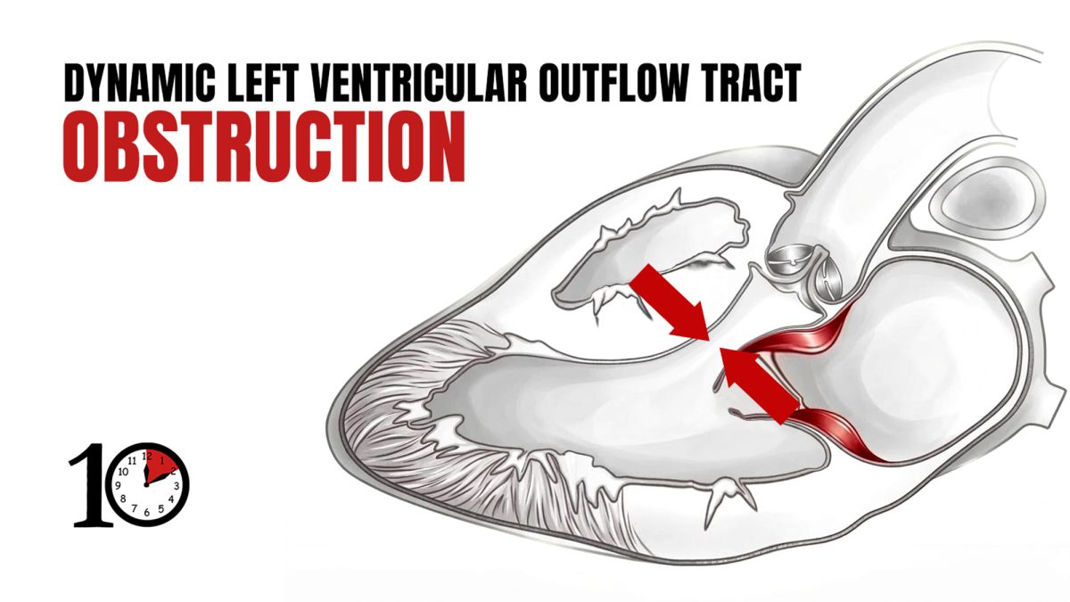 Dynamic Left Ventricular Outflow Tract Obstruction First10EM